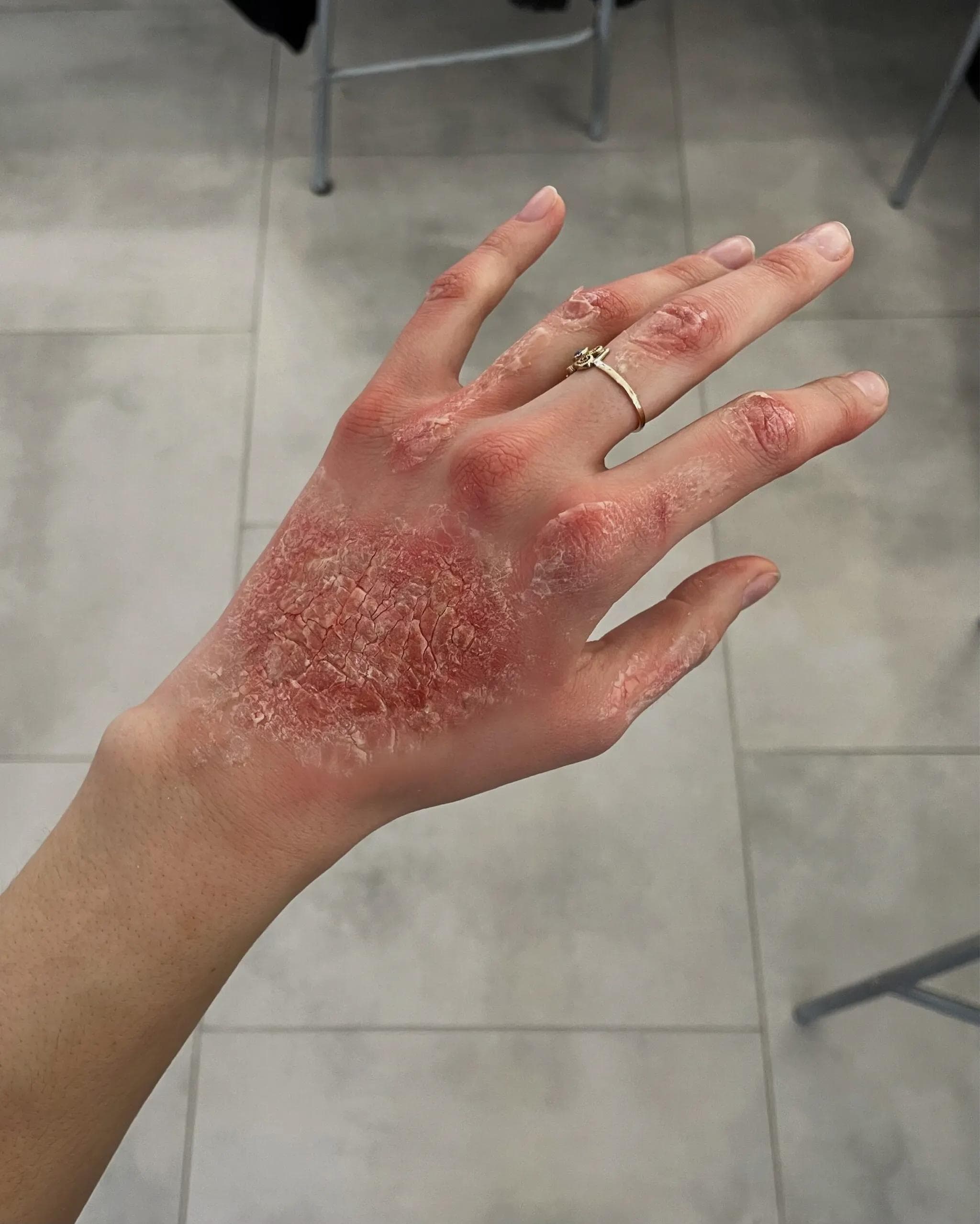 Charakteryzacja Łuszczyca